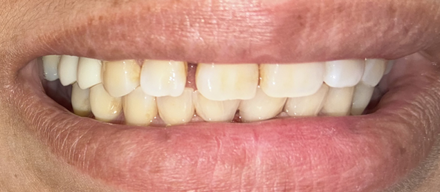 beforeafter